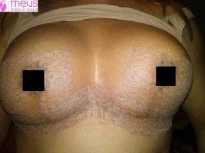 silimed 195 perfil altto-1